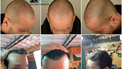 hair-transplant-istanbul (15)
