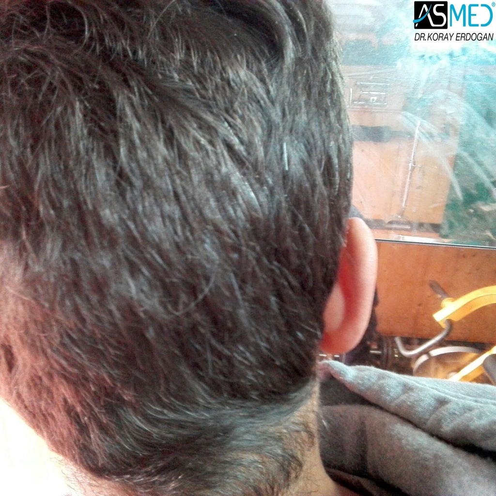 hair-transplant-istanbul (4)