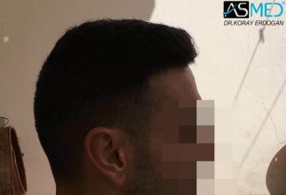 hair-transplant-koray-erdogan (16)
