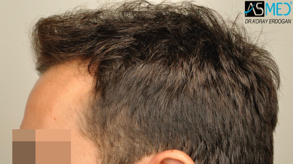 hair-transplant-koray-erdogan (4)