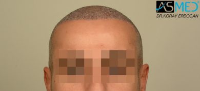 hair-transplant-koray-erdogan (7)