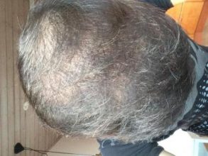 hair-transplant-money-turkey (1)