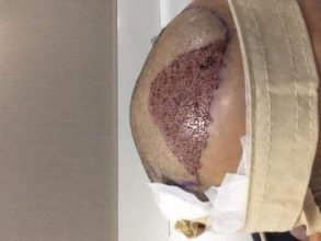hair-transplant-money-turkey (11)