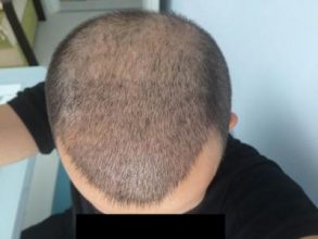 hair-transplant-money-turkey (14)