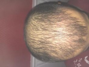 hair-transplant-money-turkey (16)