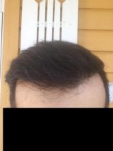 hair-transplant-money-turkey (21)
