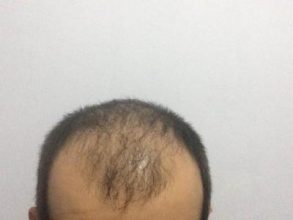 hair-transplant-money-turkey (6)