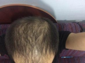 hair-transplant-money-turkey (7)