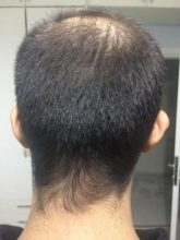 hair-transplant-money-turkey (8)