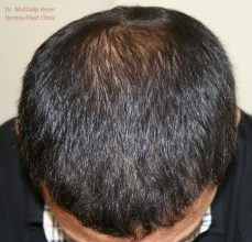 is-hair-transplant-in-turkey-safe (10)