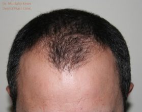 is-hair-transplant-in-turkey-safe (15)
