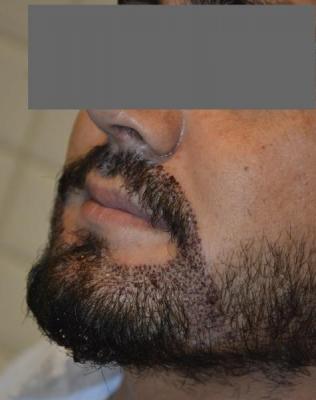 mustache-transplant (4)