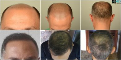 Best-hair-transplant-in-turkey (1)
