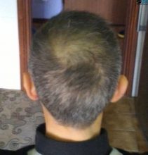 Best-hair-transplant-in-turkey (10)