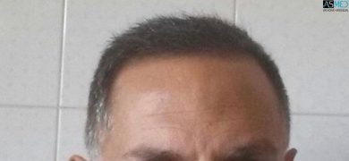 Best-hair-transplant-in-turkey (12)