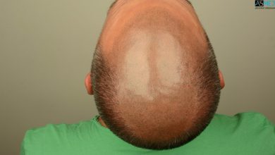 Best-hair-transplant-in-turkey (5)