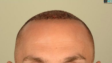 Best-hair-transplant-in-turkey (6)