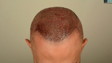 Best-hair-transplant-in-turkey (7)