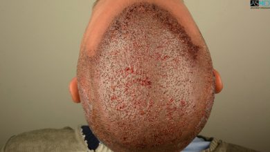 Best-hair-transplant-in-turkey (9)