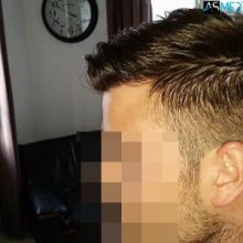 Hair-transplant-in-turkey-best-clinic (1)