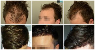 Hair-transplant-in-turkey-best-clinic (1)