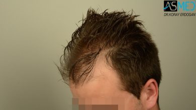 Hair-transplant-in-turkey-best-clinic (11)