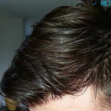 Hair-transplant-in-turkey-best-clinic (15)