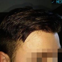 Hair-transplant-in-turkey-best-clinic (3)