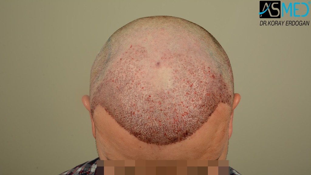 Hair-transplant-in-turkey-best-clinic (9)