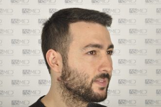 best-hair-transplant-turkey (2)