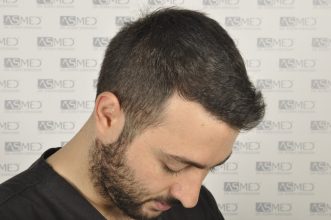 best-hair-transplant-turkey (3)