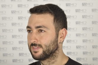 best-hair-transplant-turkey (4)