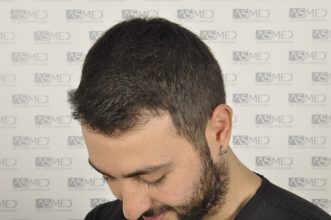 best-hair-transplant-turkey (5)