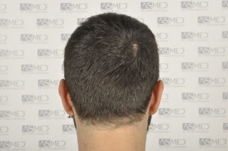 best-hair-transplant-turkey (6)