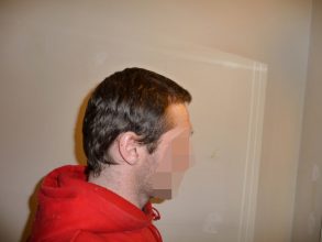 dr-keser-2300-grafts (1)