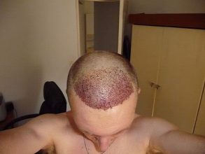 dr-keser-2300-grafts (10)