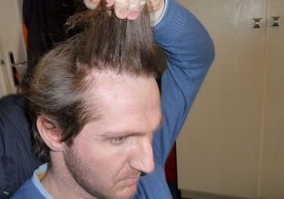 dr-keser-2300-grafts (12)