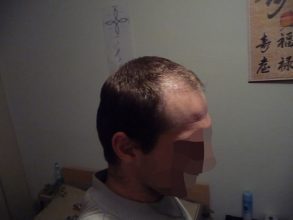 dr-keser-2300-grafts (14)