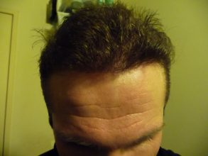 dr-keser-2300-grafts (2)