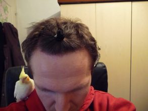 dr-keser-2300-grafts (3)