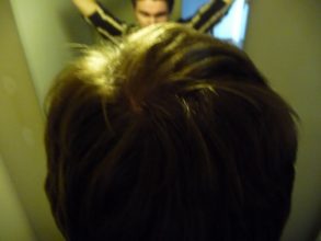 dr-keser-2300-grafts (4)