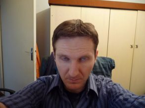 dr-keser-2300-grafts (5)