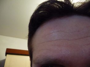 dr-keser-2300-grafts (6)