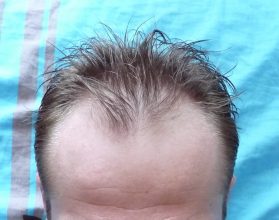 dr-keser-2300-grafts (7)