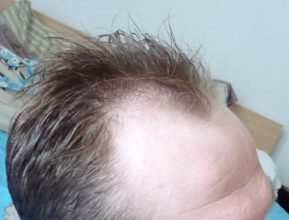 dr-keser-2300-grafts (8)