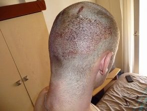 dr-keser-2300-grafts (9)