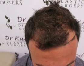 dr-kul-hair-transplant-results (10)