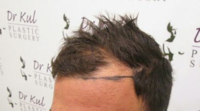 dr-kul-hair-transplant-results (11)