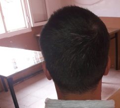 dr-kul-hair-transplant-results (13)