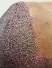 dr-kul-hair-transplant-results (14)